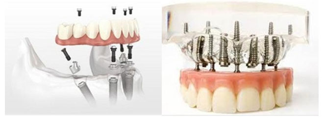 _dentalDam_implantologia_2.jpg
