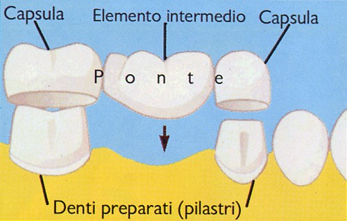 _dentalDam_protesi_2.jpg