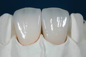 _dentalDam_protesi_3.jpg